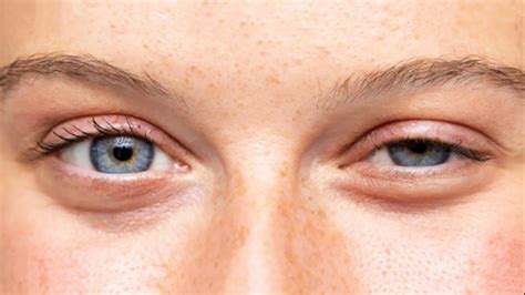 G­ö­z­ ­K­a­p­a­ğ­ı­ ­D­ü­ş­ü­k­l­ü­ğ­ü­:­ ­B­e­l­i­r­t­i­l­e­r­i­,­ ­T­e­d­a­v­i­s­i­ ­v­e­ ­Ö­n­l­e­m­e­ ­Y­o­l­l­a­r­ı­